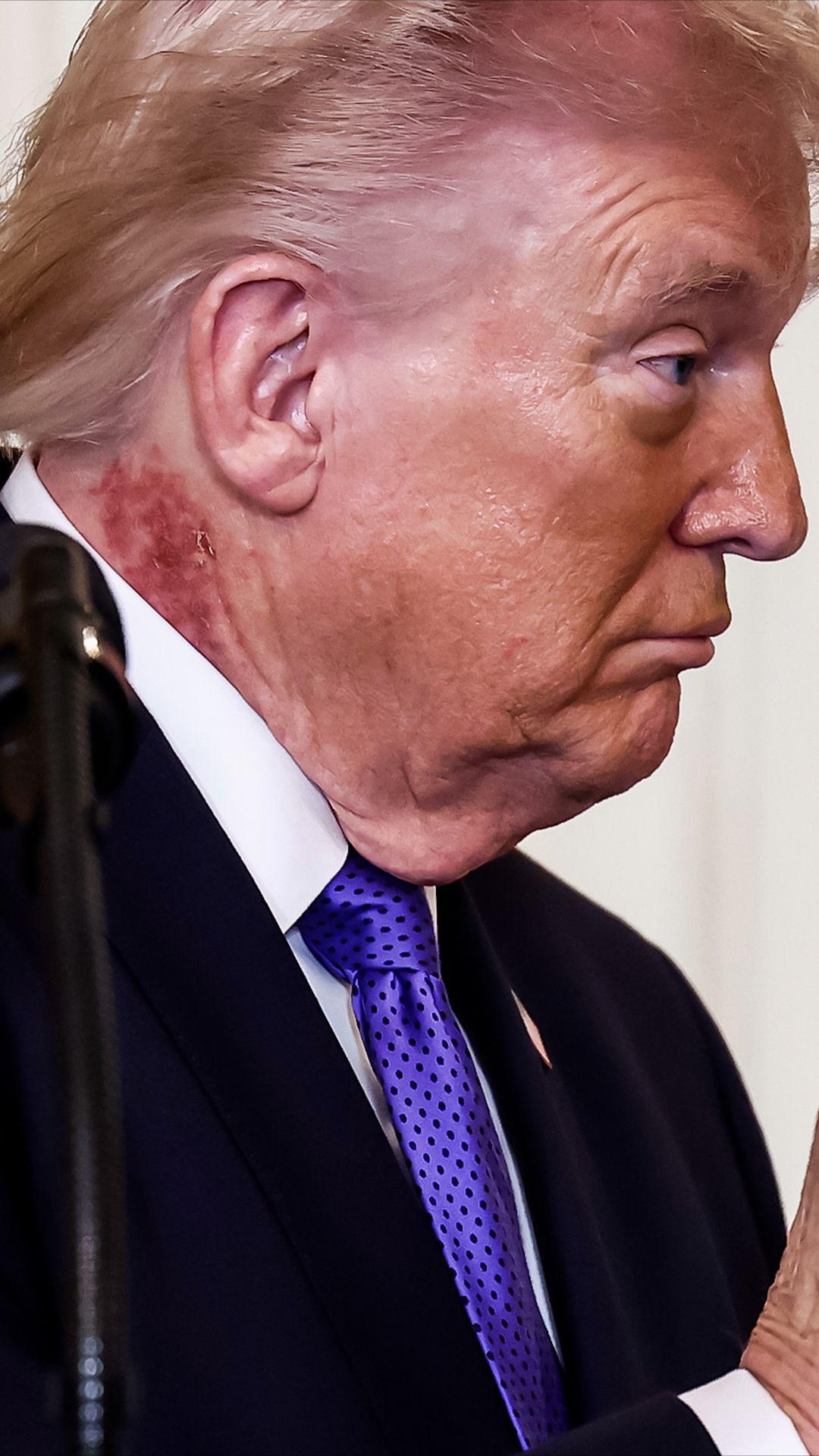 A close-up view of the skin irritation reported by aides.